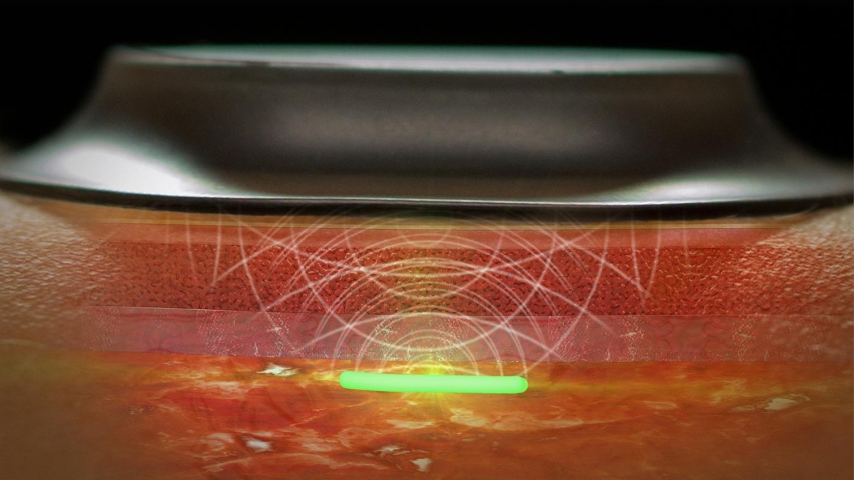 Profusa Lumee Oxygen sensor activated on skin.