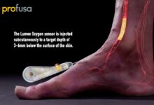 Profusa Lumee Oxygen sensor shown injected subcutaneously into the foot, targeting a depth of 3–6mm beneath the skin for real-time oxygen monitoring.