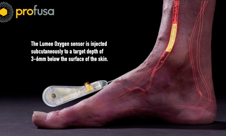 Profusa Lumee Oxygen sensor shown injected subcutaneously into the foot, targeting a depth of 3–6mm beneath the skin for real-time oxygen monitoring.