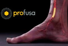 Medical illustration of a foot with glowing internal sensor and blood vessels highlighted, next to the Profusa company logo on a black background.